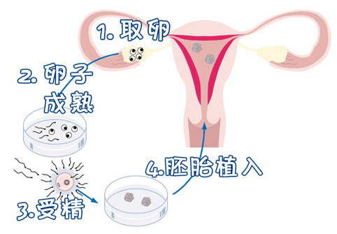 试管婴儿供卵代生咨询